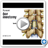 01 LUMBAR LAMINECTOMY