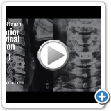 09 Anterior Cervical Fusion (ACF)